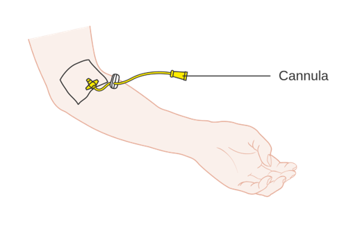 diagram of cannula on arm